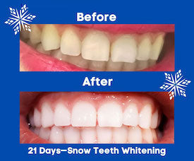 Teeth whitening