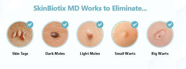 Skin tags remover